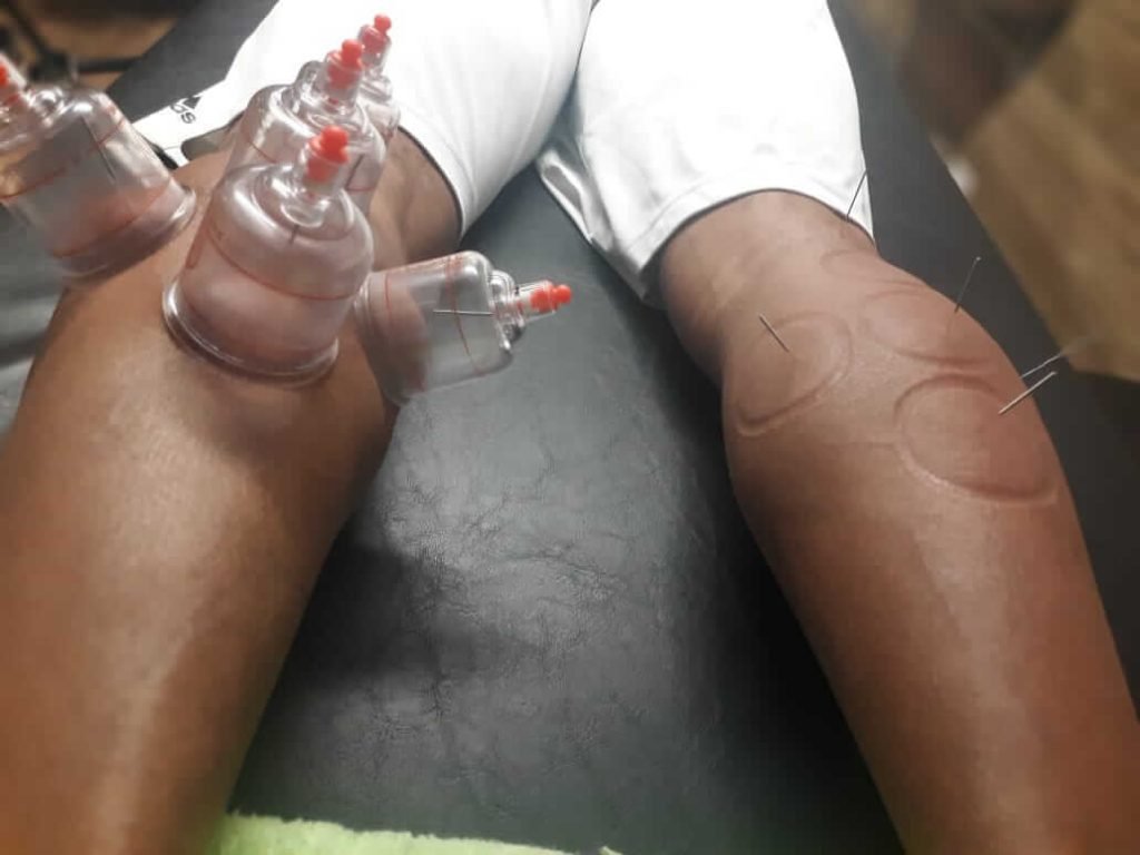 Ventosaterapia e acupuntura